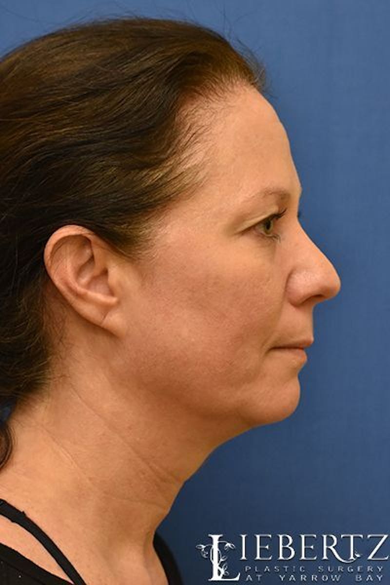 Blepharoplasty Before & After Gallery - Patient 263593 - Image 5
