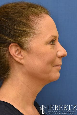 Blepharoplasty Before & After Gallery - Patient 263593 - Image 6