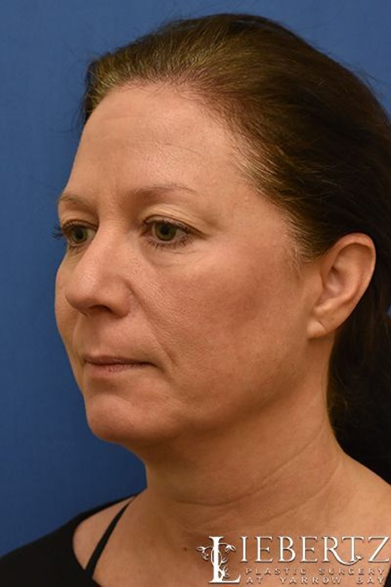 Blepharoplasty Before & After Gallery - Patient 263593 - Image 7