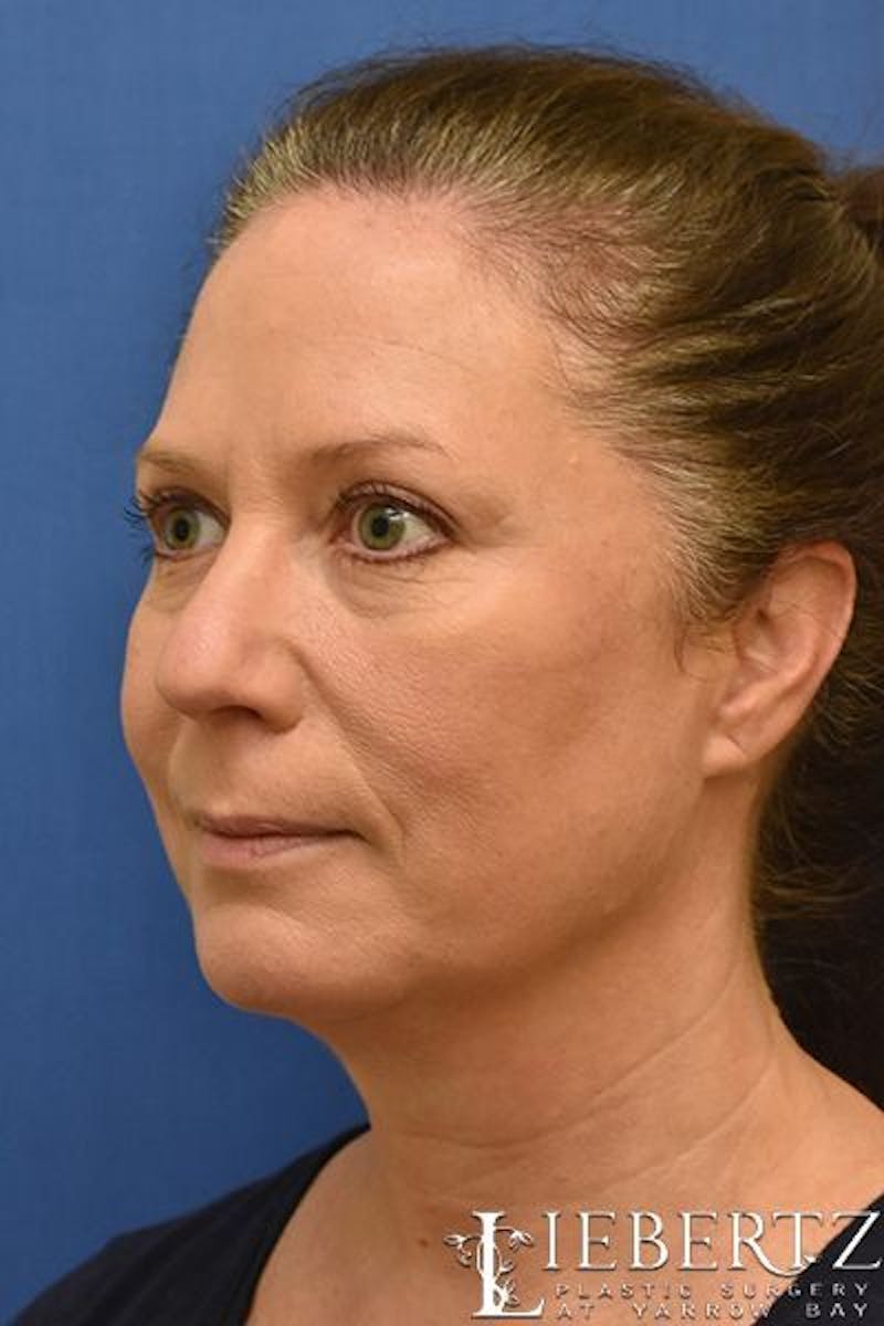 Blepharoplasty Before & After Gallery - Patient 263593 - Image 8
