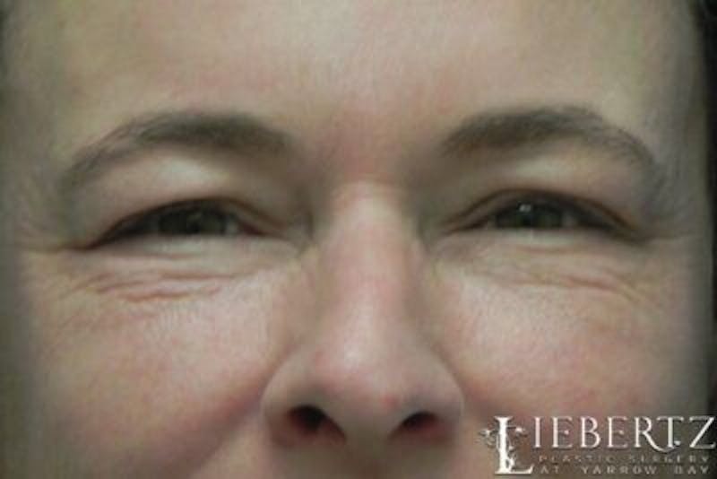 Blepharoplasty Before & After Gallery - Patient 304453 - Image 1