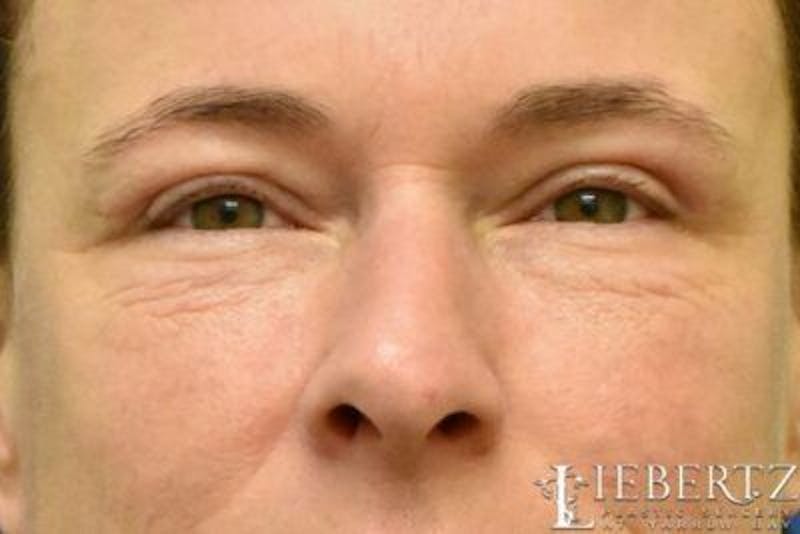 Blepharoplasty Before & After Gallery - Patient 304453 - Image 2