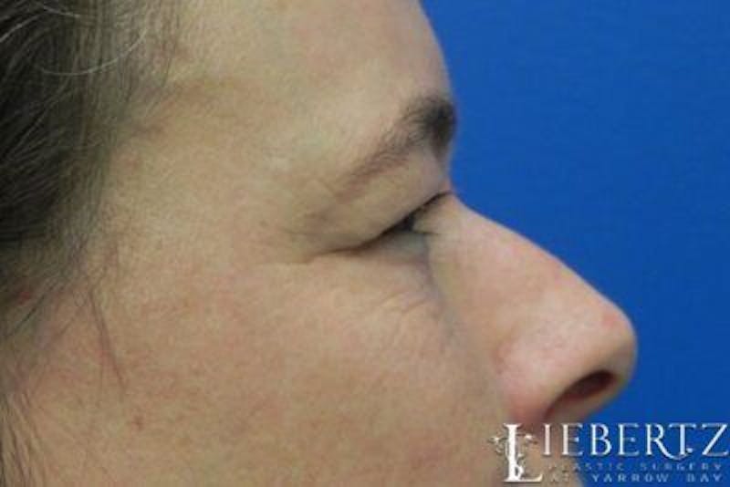 Blepharoplasty Before & After Gallery - Patient 304453 - Image 3