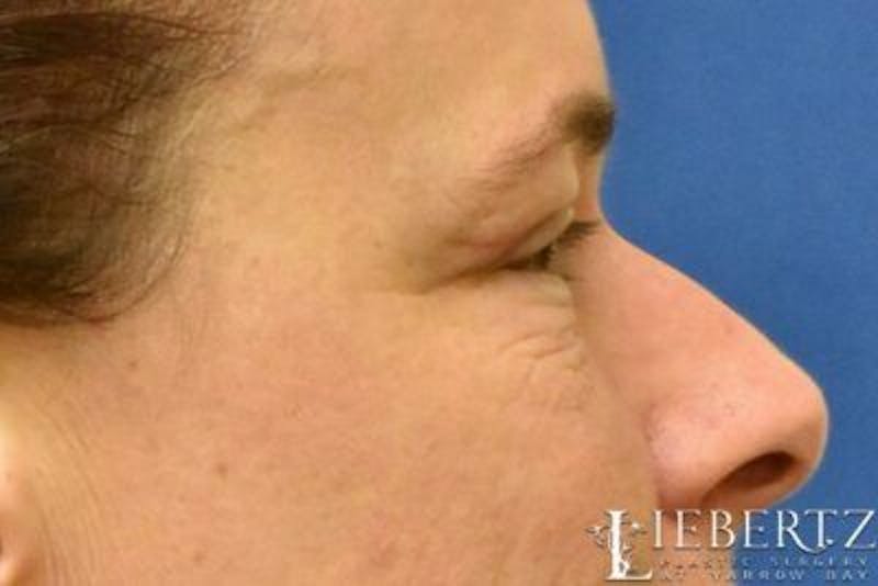 Blepharoplasty Before & After Gallery - Patient 304453 - Image 4