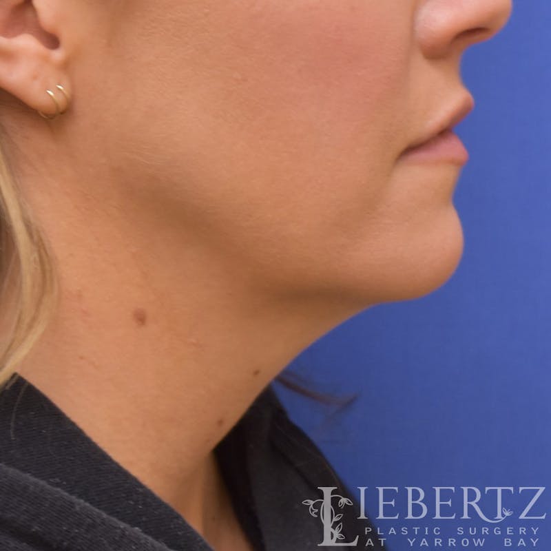 Necklift Before & After Gallery - Patient 381874 - Image 1