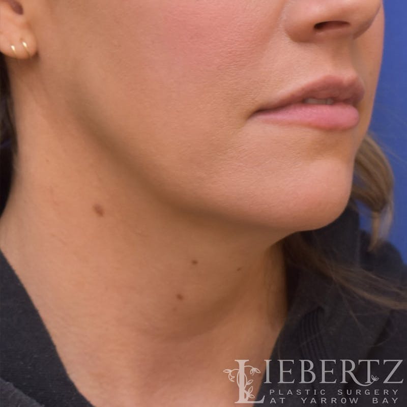 Necklift Before & After Gallery - Patient 381874 - Image 3