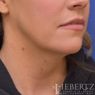 Facelift Before & After Gallery - Patient 138453 - Image 1