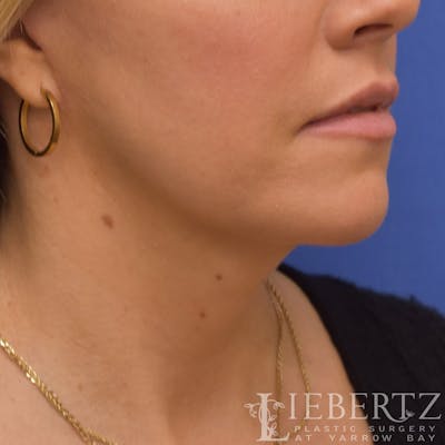 Necklift Before & After Gallery - Patient 381874 - Image 2