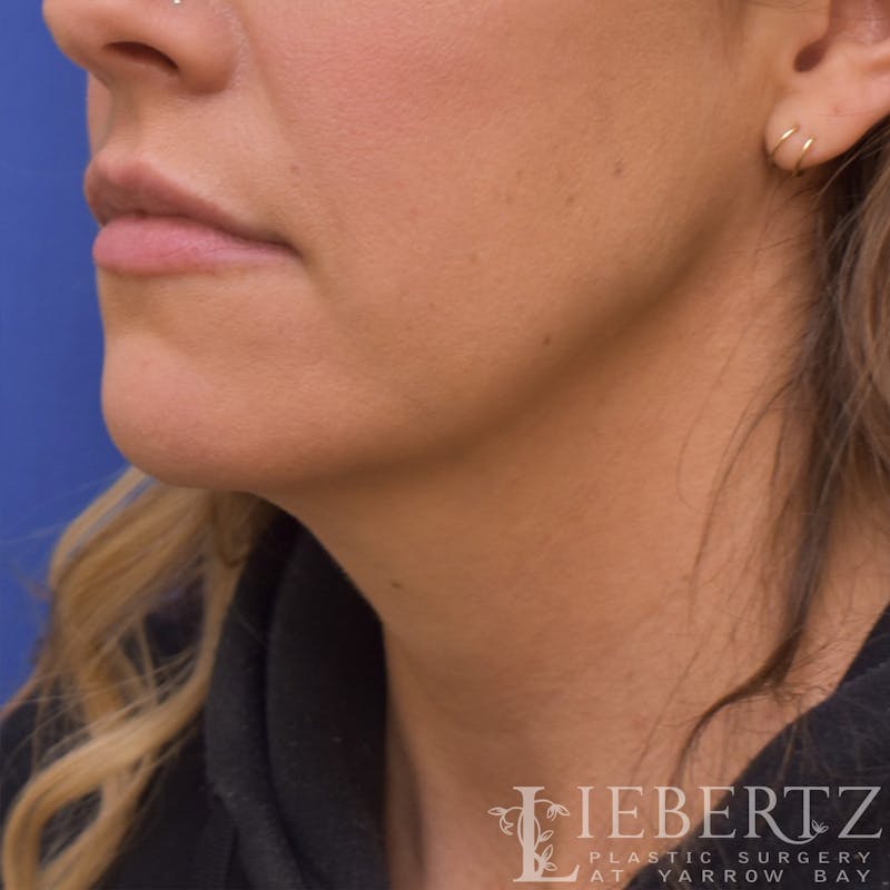 Necklift Before & After Gallery - Patient 381874 - Image 5