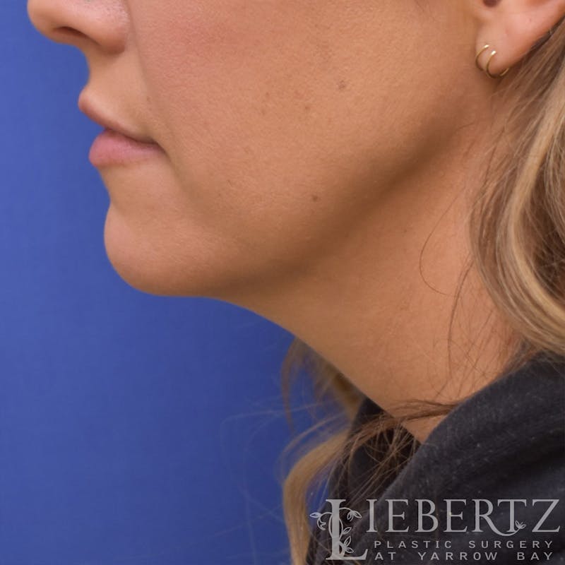 Necklift Before & After Gallery - Patient 381874 - Image 7