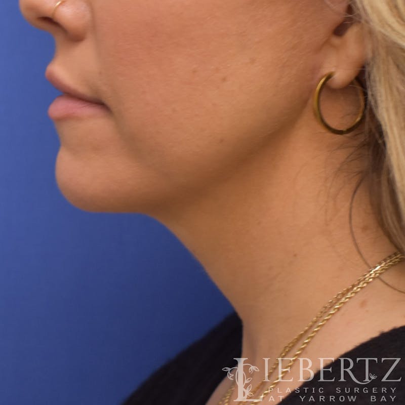 Facelift Before & After Gallery - Patient 138453 - Image 8