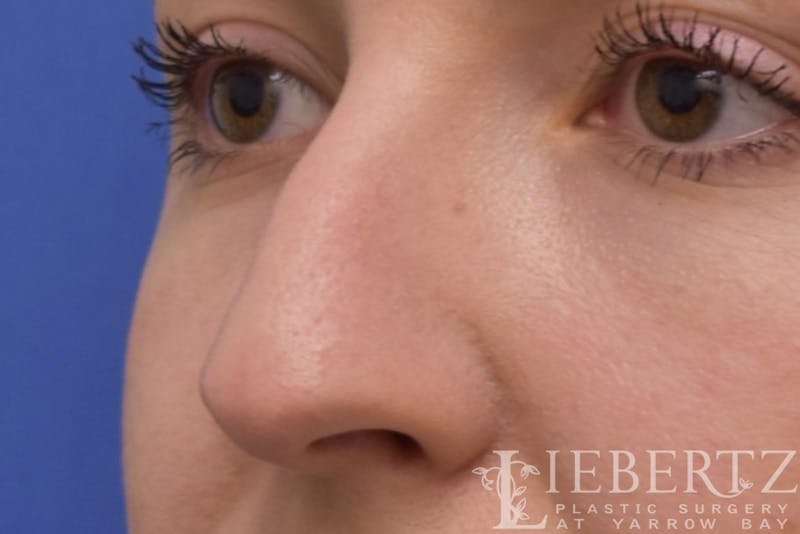 Rhinoplasty Before & After Gallery - Patient 172173 - Image 1