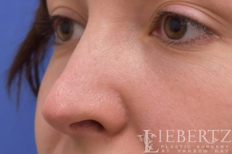 Rhinoplasty Before & After Gallery - Patient 172173 - Image 2