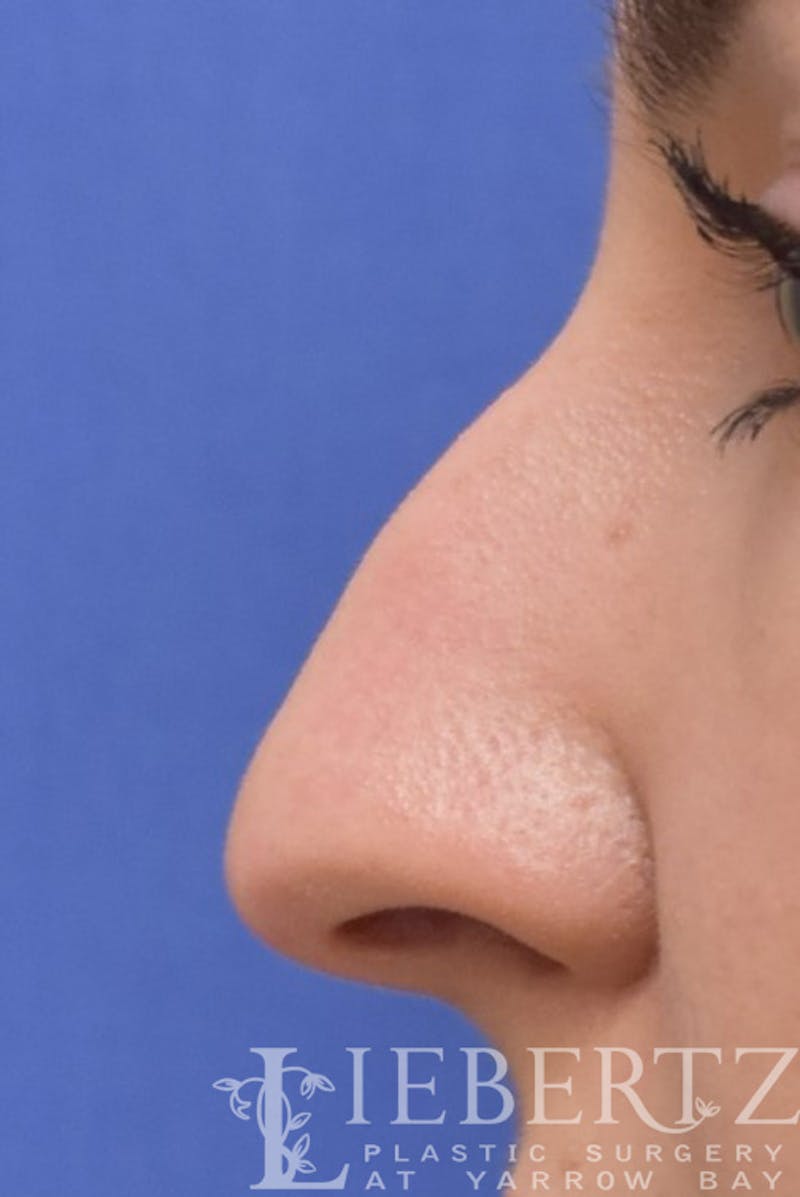 Rhinoplasty Before & After Gallery - Patient 172173 - Image 3