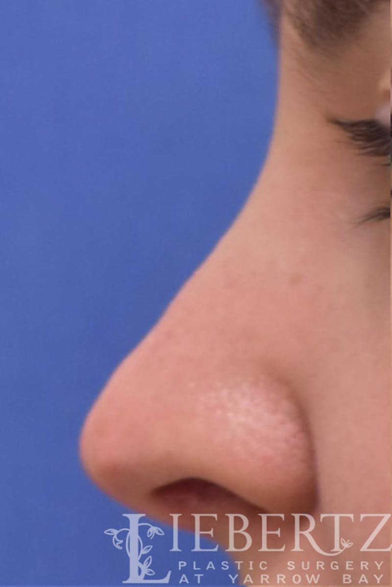 Rhinoplasty Before & After Gallery - Patient 172173 - Image 4