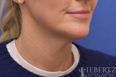 Necklift Before & After Gallery - Patient 371806 - Image 1