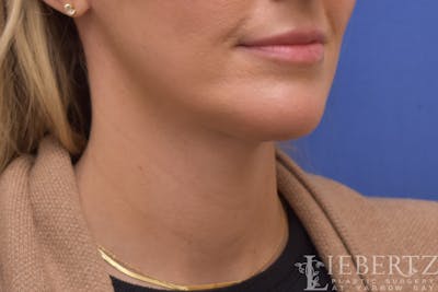Necklift Before & After Gallery - Patient 371806 - Image 2