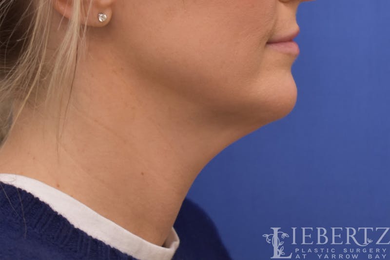 Necklift Before & After Gallery - Patient 371806 - Image 3