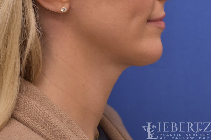 Necklift Before & After Gallery - Patient 371806 - Image 4