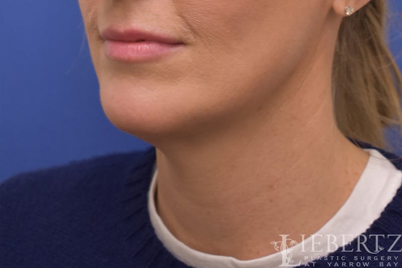 Necklift Before & After Gallery - Patient 371806 - Image 5
