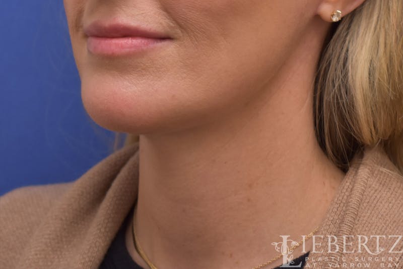 Necklift Before & After Gallery - Patient 371806 - Image 6