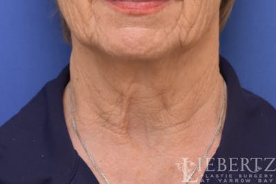 Necklift Before & After Gallery - Patient 370813 - Image 1