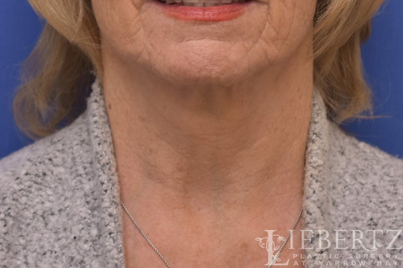Necklift Before & After Gallery - Patient 370813 - Image 2