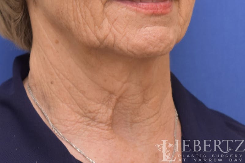 Necklift Before & After Gallery - Patient 370813 - Image 3