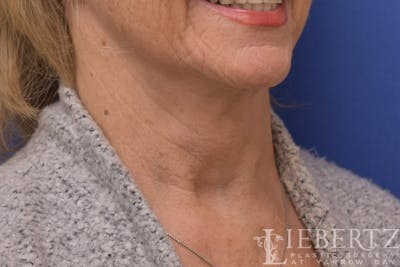 Necklift Before & After Gallery - Patient 370813 - Image 2