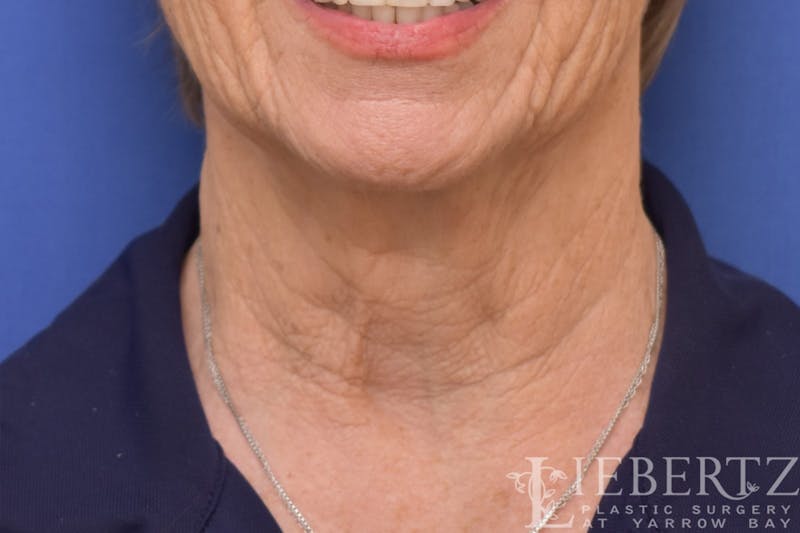 Necklift Before & After Gallery - Patient 370813 - Image 5