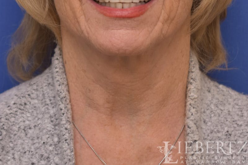 Necklift Before & After Gallery - Patient 370813 - Image 6