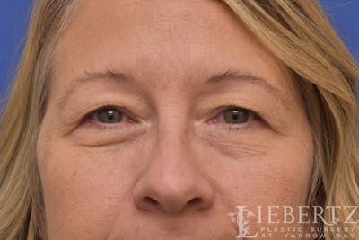 Blepharoplasty Before & After Gallery - Patient 244045 - Image 1