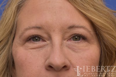 Blepharoplasty Before & After Gallery - Patient 244045 - Image 2