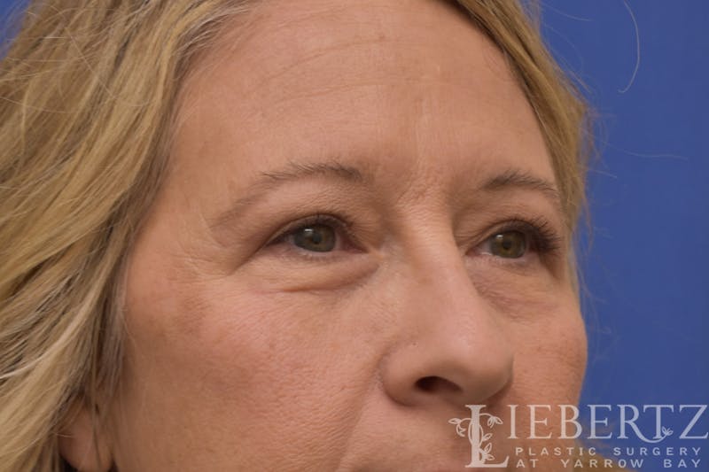Blepharoplasty Before & After Gallery - Patient 244045 - Image 4