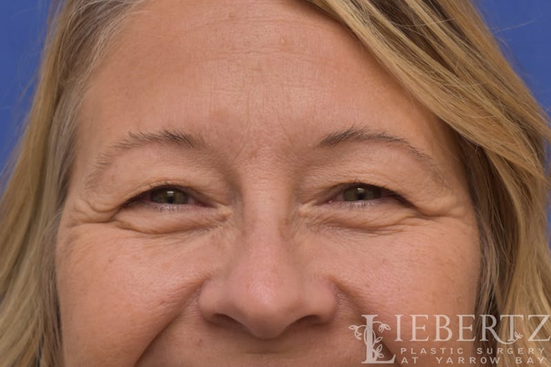 Blepharoplasty Before & After Gallery - Patient 244045 - Image 5