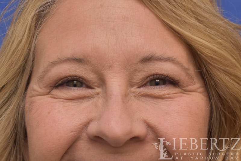 Blepharoplasty Before & After Gallery - Patient 244045 - Image 6