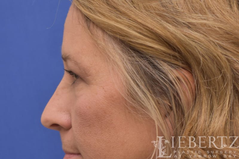 Blepharoplasty Before & After Gallery - Patient 244045 - Image 8