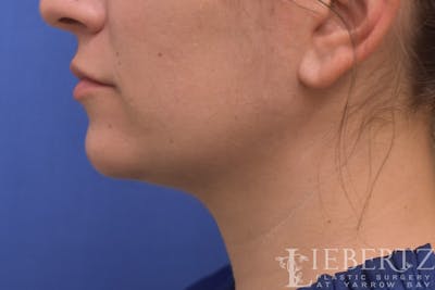 Submental Liposuction Before & After Gallery - Patient 120095 - Image 2