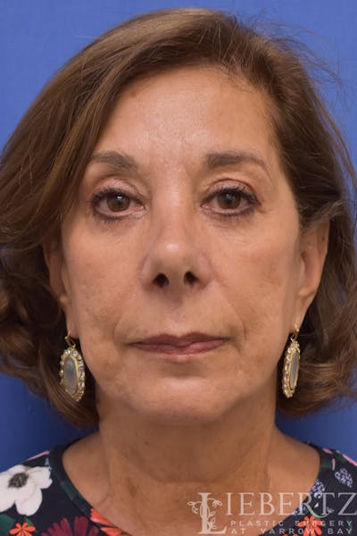 Facelift Before & After Gallery - Patient 973848 - Image 2