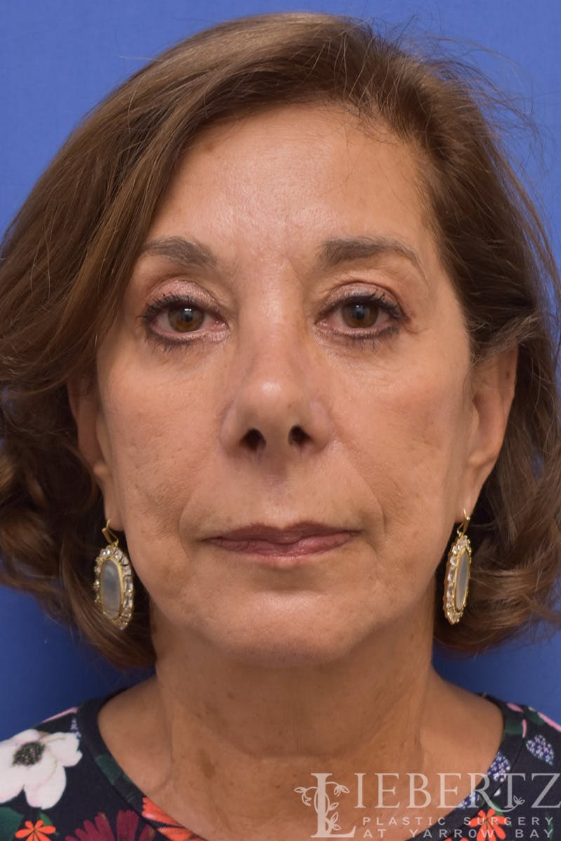 Facelift Before & After Gallery - Patient 973848 - Image 2
