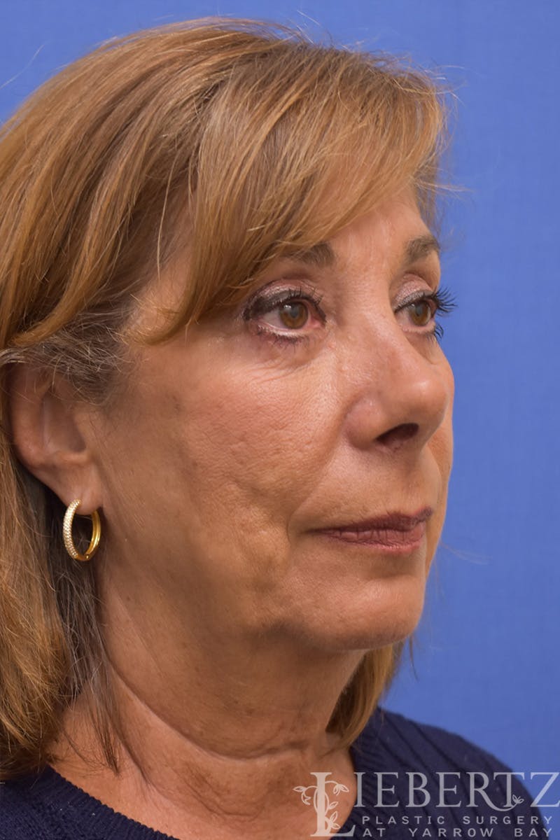 Facelift Before & After Gallery - Patient 973848 - Image 3