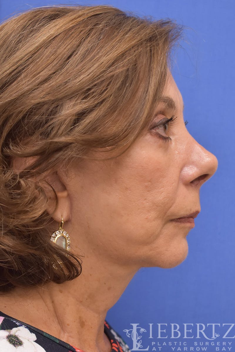 Facelift Before & After Gallery - Patient 973848 - Image 6