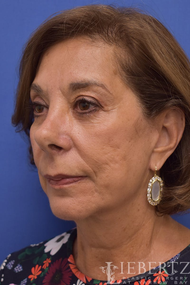 Facelift Before & After Gallery - Patient 973848 - Image 8