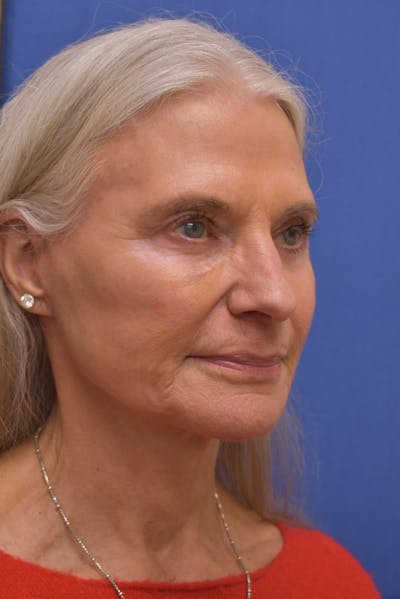 Necklift Before & After Gallery - Patient 965488 - Image 2