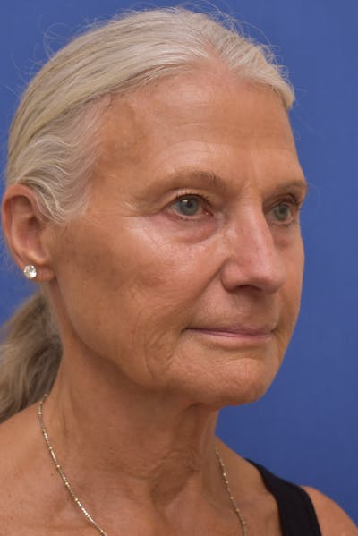 Facelift Before & After Gallery - Patient 169532 - Image 1