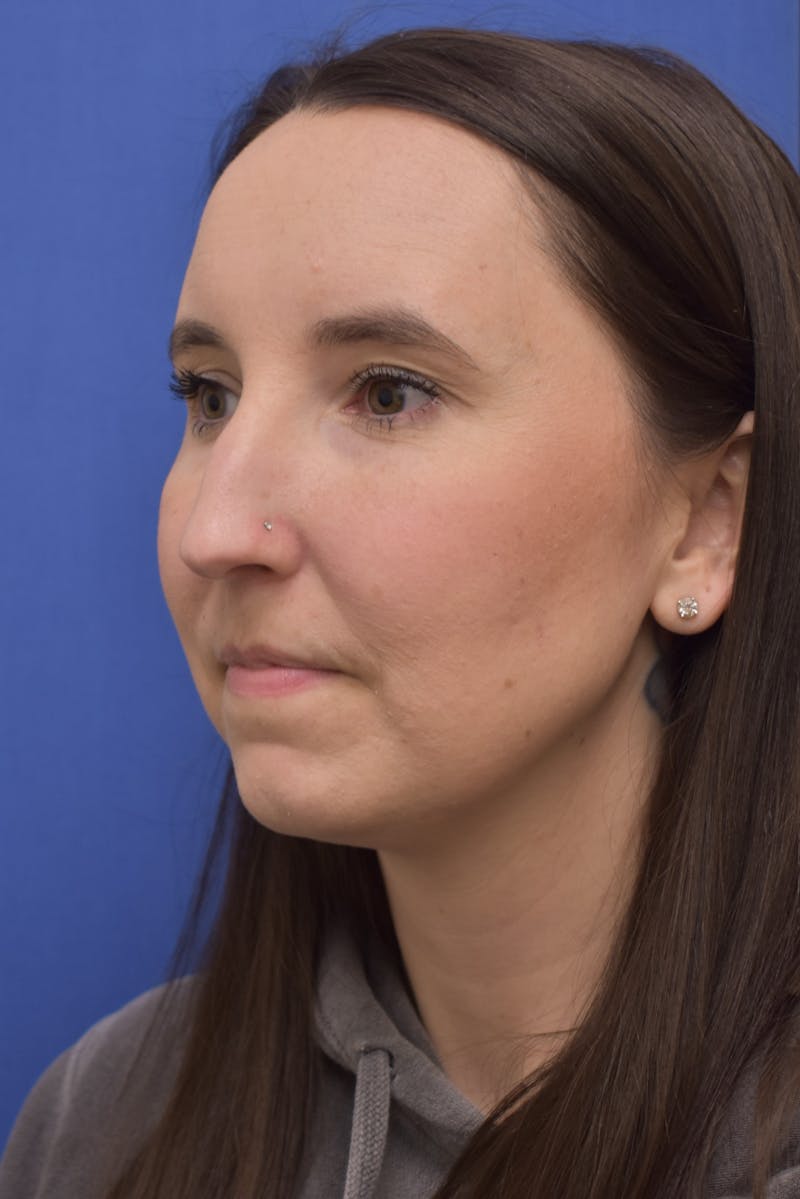 Rhinoplasty Before & After Gallery - Patient 936966 - Image 3