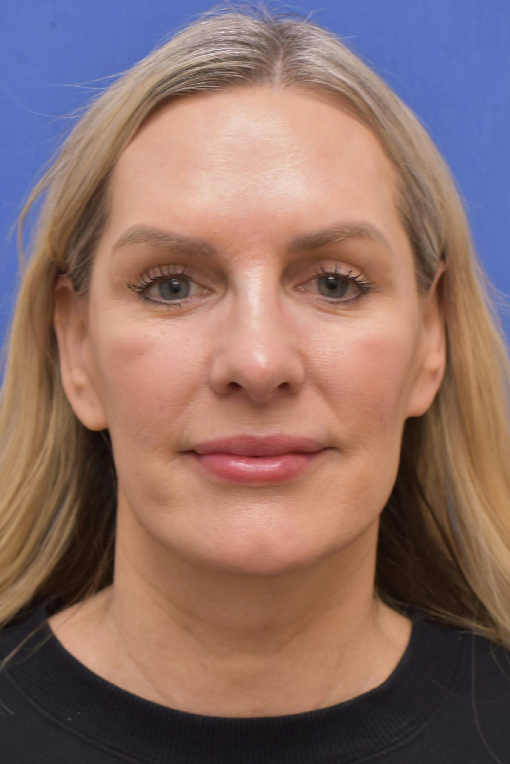 facelift