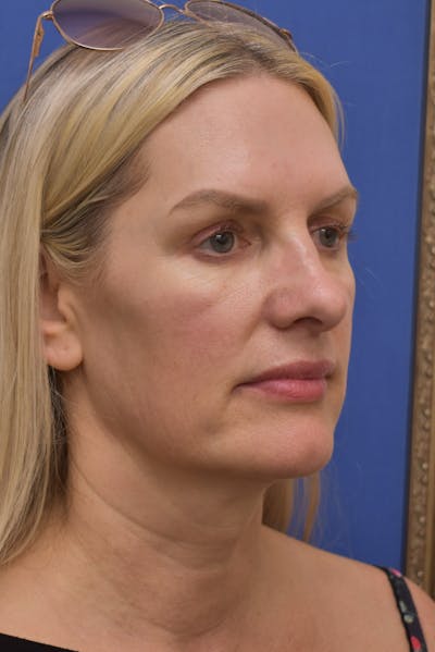 Facelift Before & After Gallery - Patient 396021 - Image 1