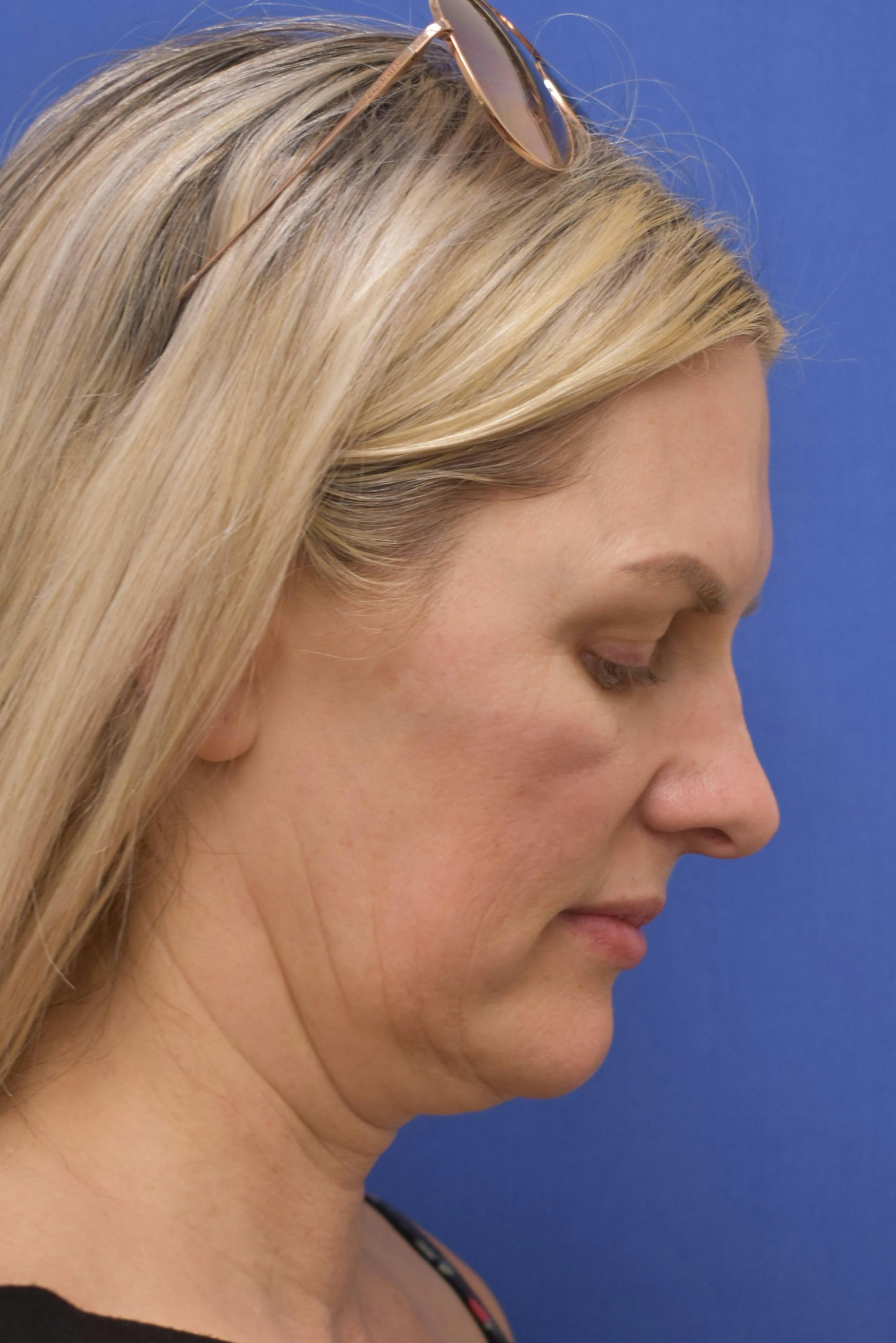 facelift