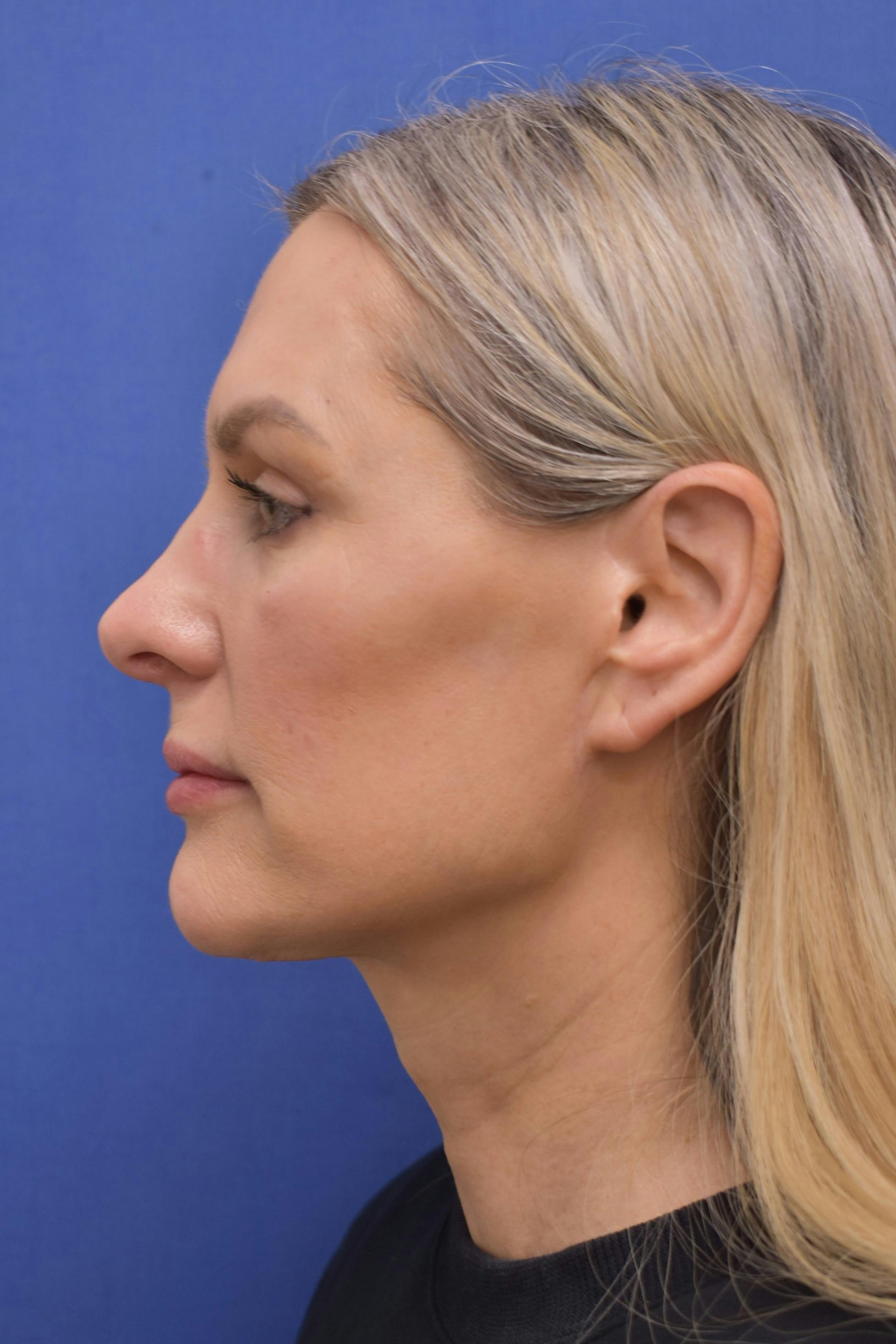 facelift